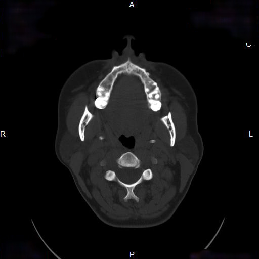 File:Chronic maxillary sinusitis with a foreign body (dental filling material) (Radiopaedia 7811-8639 Axial bone window 1).jpg