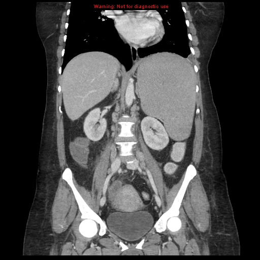 File:Chronic myeloid leukemia with splenic infarction (Radiopaedia 9178-9874 E 41).jpg
