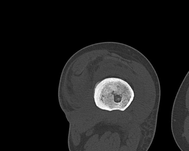 Chronic ostemyelitis of the femur with long sinus tract (Radiopaedia 74947-85982 Axial bone window 165).jpg