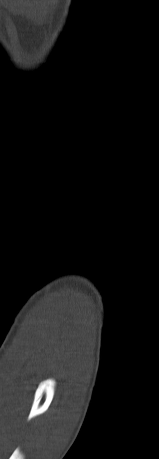 Chronic osteomyelitis of the distal humerus (Radiopaedia 78351-90971 Sagittal bone window 24).jpg