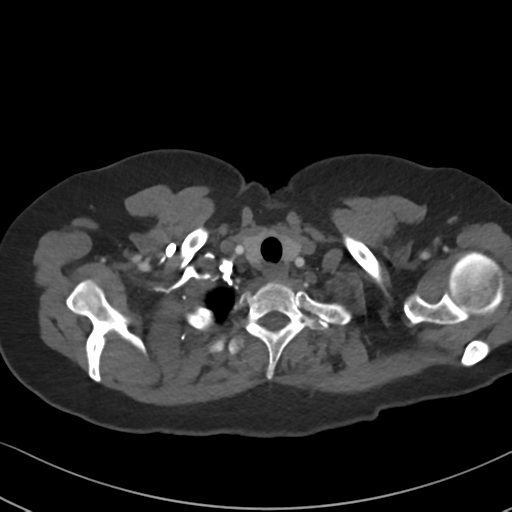 Chronic pulmonary embolus (Radiopaedia 39129-41341 Axial C+ CTPA 10).png