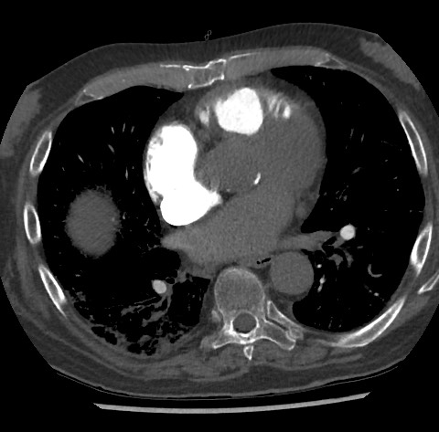 File:Chronic thromboembolic pulmonary disease (Radiopaedia 90694-108119 Axial C+ CTPA 58).jpg