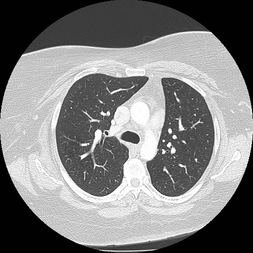 Cicatrisation collapse (Radiopaedia 17405-17089 lung window 42).jpg