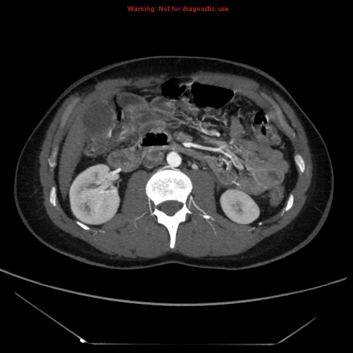 File:Circumaortic left renal vein (Radiopaedia 9069-9792 A 26).jpg