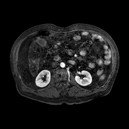 Cirrhosis and hepatocellular carcinoma in the setting of hemochromatosis (Radiopaedia 75394-86594 Axial T1 C+ fat sat 103).jpg