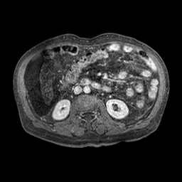 Cirrhosis and hepatocellular carcinoma in the setting of hemochromatosis (Radiopaedia 75394-86594 Axial T1 C+ fat sat 271).jpg