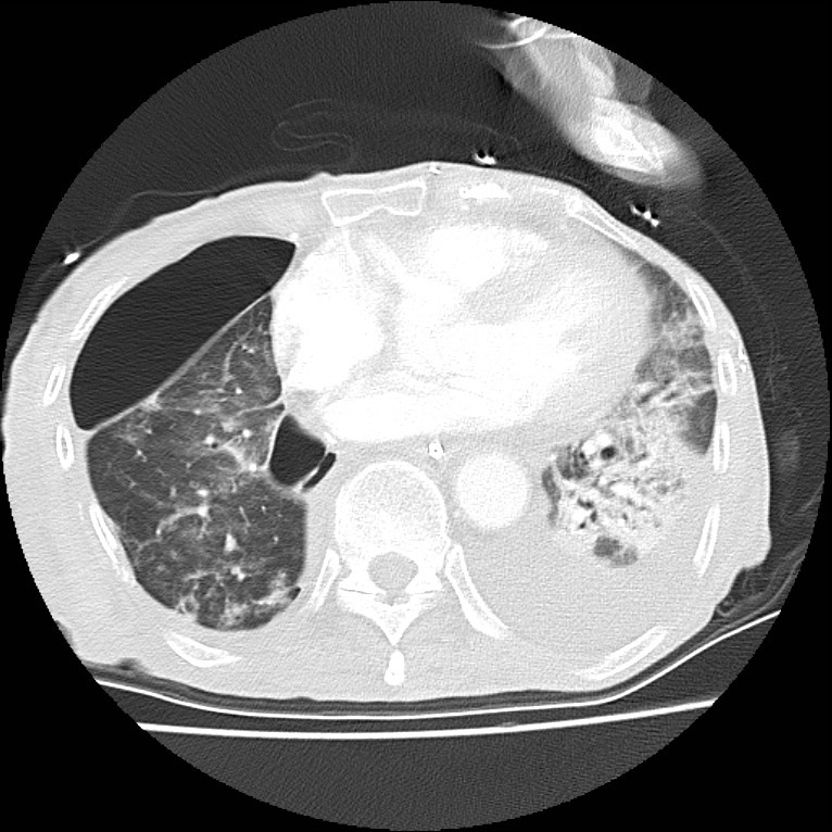 Clagett thoracotomy with bronchopleural fistula (Radiopaedia 29192-29587 Axial lung window 33).jpg