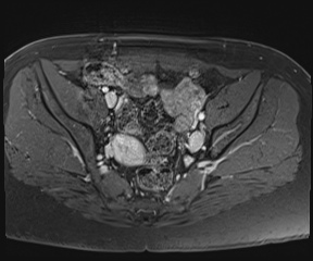 File:Class II Mullerian duct anomaly- unicornuate uterus with rudimentary horn and non-communicating cavity (Radiopaedia 39441-41755 Axial T1 fat sat 46).jpg