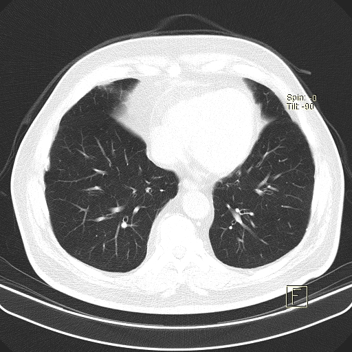 Classic complicated silicosis (Radiopaedia 49720-54961 Axial lung window 41).jpg