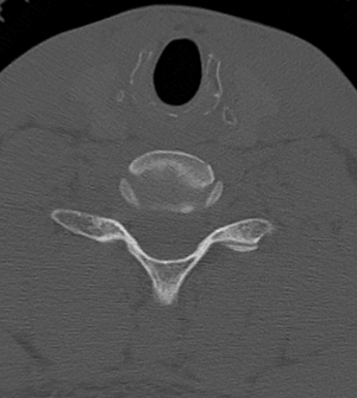 Clay-shoveler fracture (Radiopaedia 14604-14532 Axial bone window 19).jpg