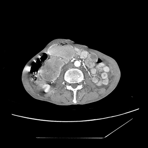 Closed-loop obstruction due to peritoneal seeding mimicking internal hernia after total gastrectomy (Radiopaedia 81897-95864 A 101).jpg