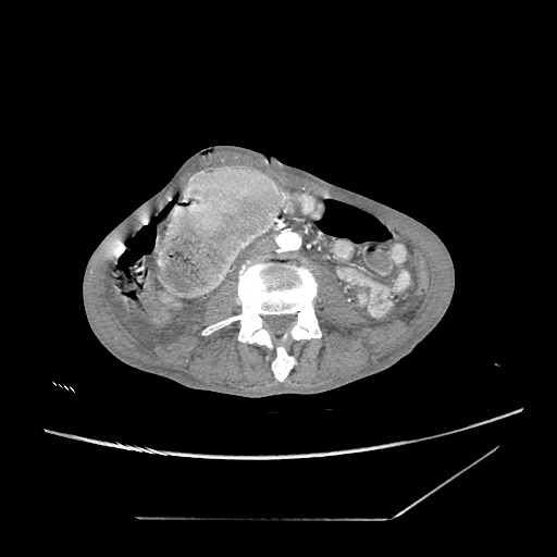 Closed-loop obstruction due to peritoneal seeding mimicking internal hernia after total gastrectomy (Radiopaedia 81897-95864 A 113).jpg
