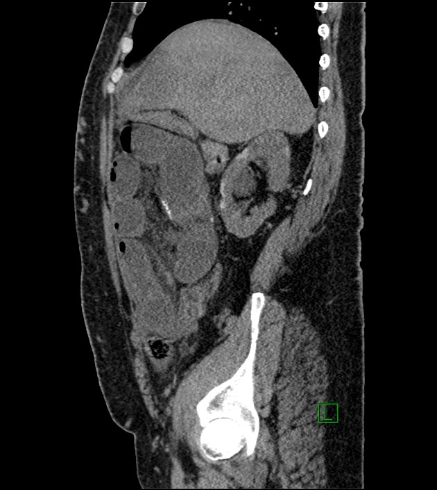 Closed-loop small bowel obstruction-internal hernia (Radiopaedia 78439-91096 C 104).jpg