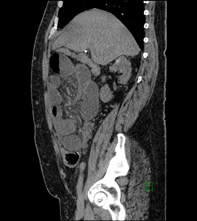 Closed-loop small bowel obstruction-internal hernia (Radiopaedia 78439-91096 C 98).jpg