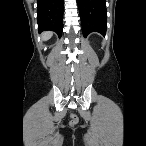File:Closed-loop small bowel obstruction (Radiopaedia 73713-84509 C 101).jpg