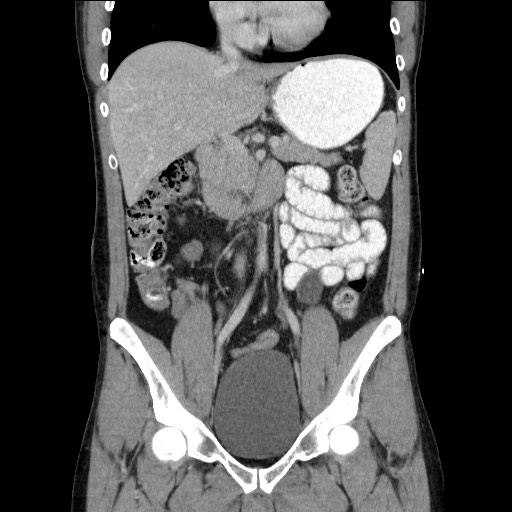File:Closed-loop small bowel obstruction (Radiopaedia 73713-84509 C 60).jpg