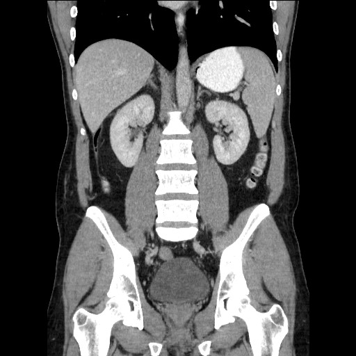 File:Closed-loop small bowel obstruction (Radiopaedia 73713-84509 C 77).jpg