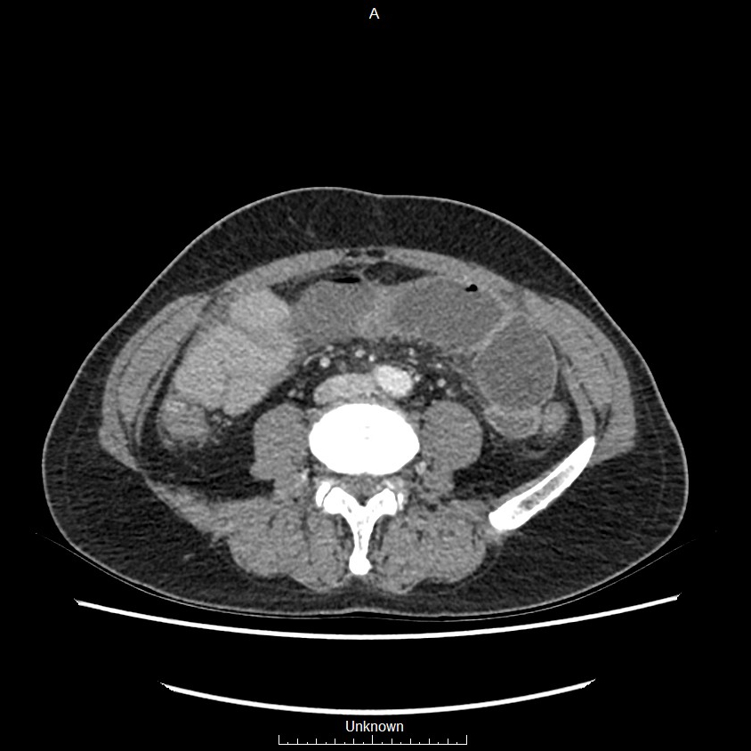 Closed loop bowel obstruction and ischemia (Radiopaedia 86959-103180 A 49).jpg