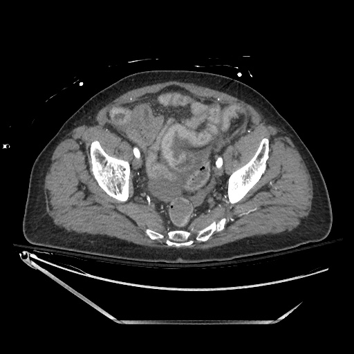 File:Closed loop obstruction due to adhesive band, resulting in small bowel ischemia and resection (Radiopaedia 83835-99023 Axial 244).jpg
