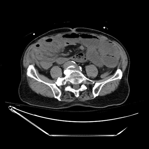 Closed loop obstruction due to adhesive band, resulting in small bowel ischemia and resection (Radiopaedia 83835-99023 Axial non-contrast 102).jpg