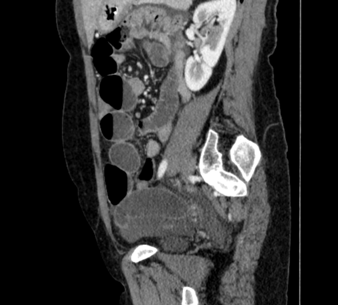 Closed loop small bowel obstruction (Radiopaedia 71211-81508 C 109).jpg