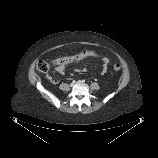 Closed loop small bowel obstruction - internal hernia (Radiopaedia 65402-74450 A 84).jpg