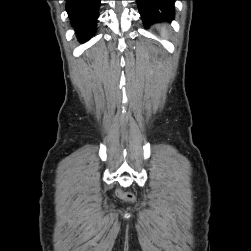 Closed loop small bowel obstruction - omental adhesion causing "internal hernia" (Radiopaedia 85129-100682 B 113).jpg