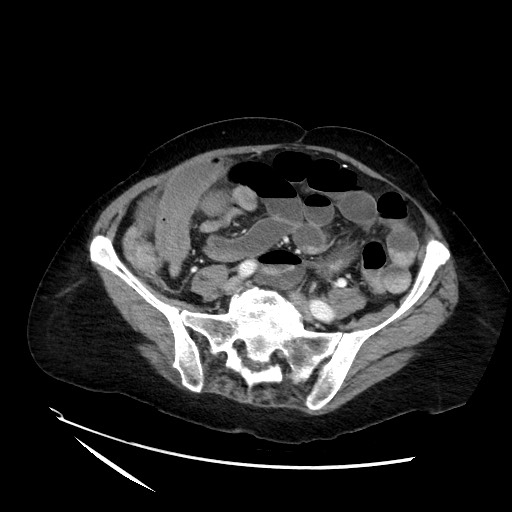 File:Closed loop small bowel obstruction due to adhesive band, with intramural hemorrhage and ischemia (Radiopaedia 83831-99017 Axial 40).jpg