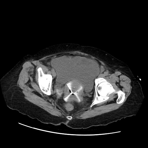 Closed loop small bowel obstruction due to adhesive band, with intramural hemorrhage and ischemia (Radiopaedia 83831-99017 Axial non-contrast 143).jpg