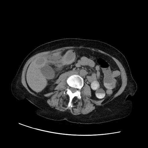 File:Closed loop small bowel obstruction due to adhesive band, with intramural hemorrhage and ischemia (Radiopaedia 83831-99017 Axial non-contrast 81).jpg