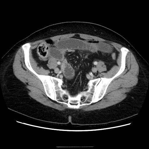 Closed loop small bowel obstruction due to adhesive bands - early and late images (Radiopaedia 83830-99015 A 127).jpg