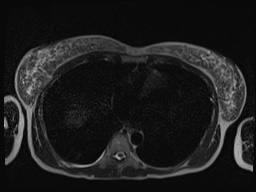 File:Closed loop small bowel obstruction in pregnancy (MRI) (Radiopaedia 87637-104031 Axial T2 2).jpg