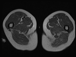 Closed loop small bowel obstruction in pregnancy (MRI) (Radiopaedia 87637-104031 D 54).jpg