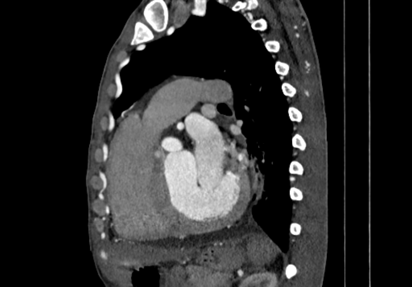 Coarctation of aorta with aortic valve stenosis (Radiopaedia 70463-80574 B 102).jpg
