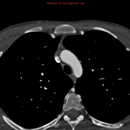 File:Coarctation of the aorta (Radiopaedia 12461-12697 A 48).jpg