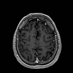 File:Cochlear incomplete partition type III associated with hypothalamic hamartoma (Radiopaedia 88756-105498 Axial T1 C+ 153).jpg