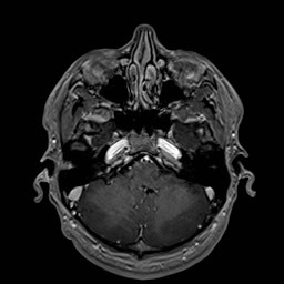 File:Cochlear incomplete partition type III associated with hypothalamic hamartoma (Radiopaedia 88756-105498 Axial T1 C+ 56).jpg