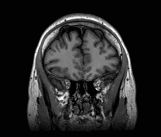 File:Cochlear incomplete partition type III associated with hypothalamic hamartoma (Radiopaedia 88756-105498 Coronal T1 48).jpg