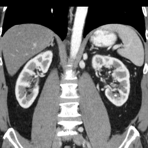 File:Collateral circulation following left renal vein thrombosis (Radiopaedia 17319-17013 renal cortical phase 10).jpg