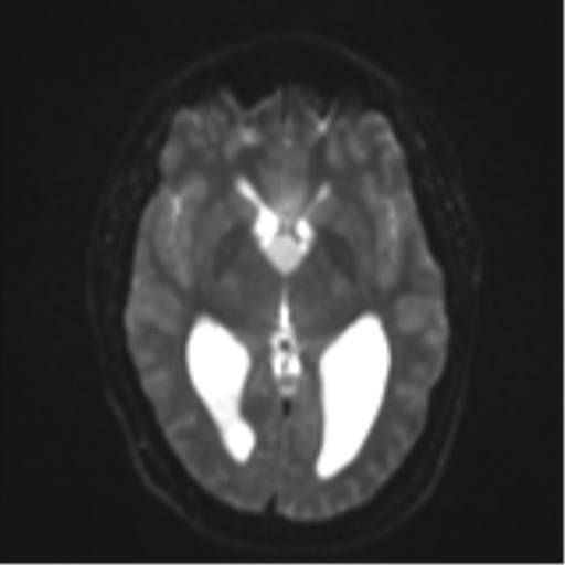 File:Colloid cyst (Radiopaedia 44510-48181 Axial DWI 13).png