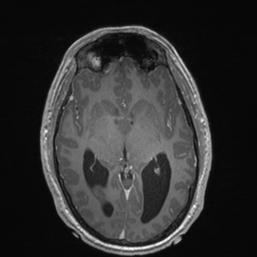 File:Colloid cyst (Radiopaedia 44510-48181 Axial T1 C+ 87).png