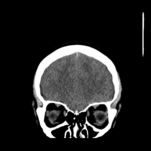 Colloid cyst (resulting in death) (Radiopaedia 33423-34469 Coronal non-contrast 11).png