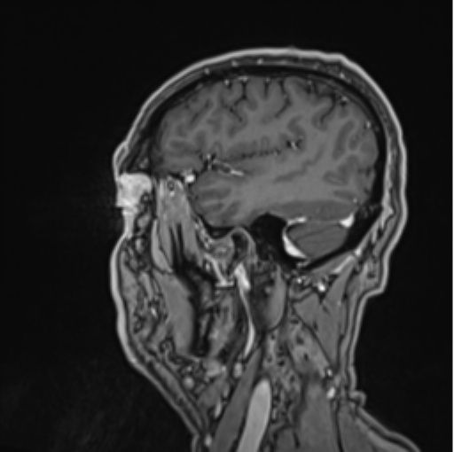 File:Colloid cyst of the third ventricle (Radiopaedia 86571-102662 Sagittal T1 C+ 62).png