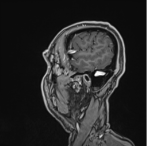 Colloid cyst of the third ventricle (Radiopaedia 86571-102662 Sagittal T1 C+ 68).png