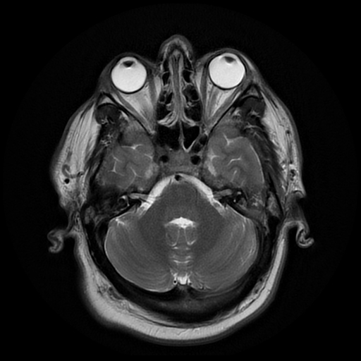 File:Colloid cyst with anterior communicating artery aneurysm (Radiopaedia 33901-35091 Axial T2 6).jpg