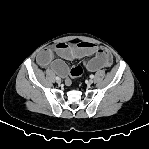 File:Colocolic intussusception due to large lipoma (Radiopaedia 68773-78482 A 148).jpg