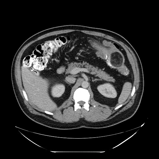 Colocolic intussusception due to lipoma (Radiopaedia 73712-84508 A 38).jpg