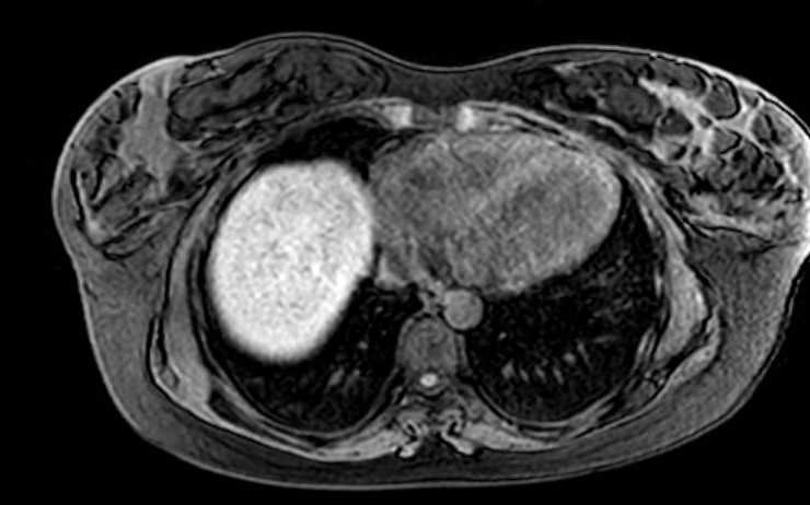 Colon adenocarcinoma with Krukenberg tumors, advanced pregnancy (Radiopaedia 67279-76645 A 78).jpg