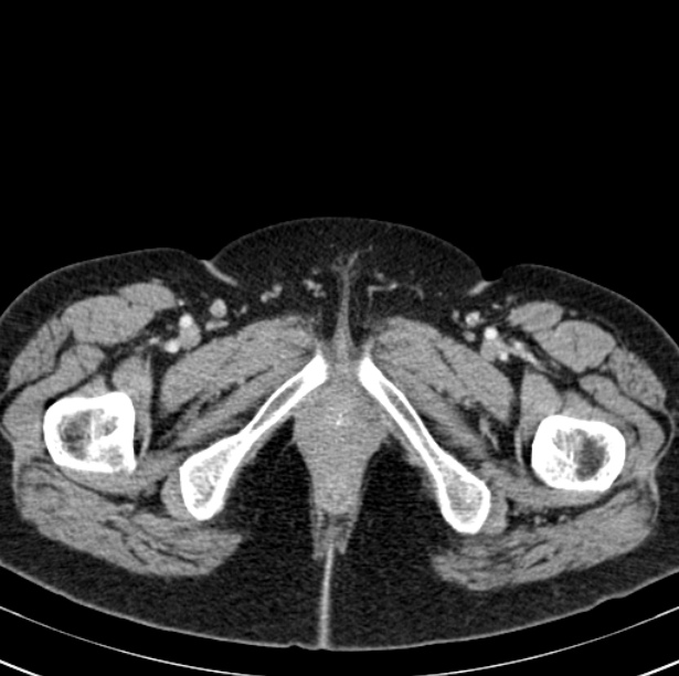 Colon carcinoma with hepatic metastases (Radiopaedia 29477-29961 A 124).jpg