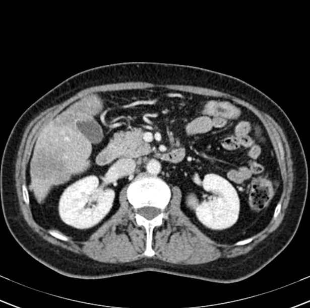 Colon carcinoma with hepatic metastases (Radiopaedia 29477-29961 A 45).jpg
